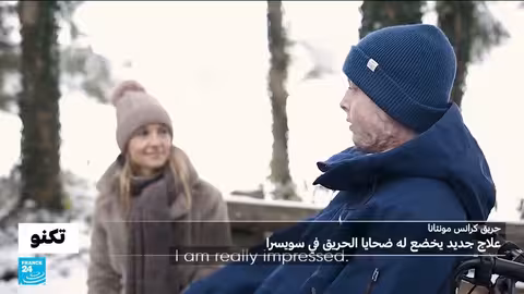 علاج جديد للحروق الشديدة يزيل الندوب في سويسرا