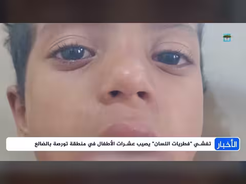 انتشار فطريات اللسان في تورصة