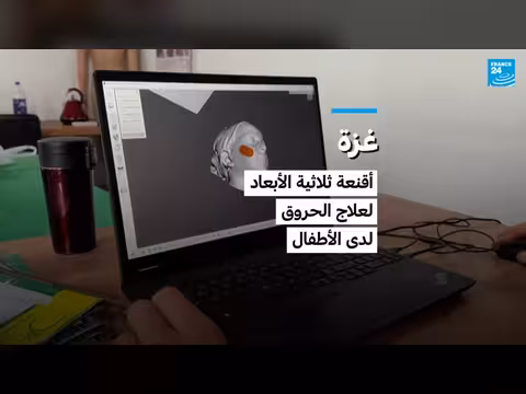 غزة: استخدام أقنعة ثلاثية الأبعاد لعلاج الحروق