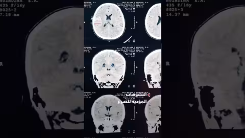 الذكاء الاصطناعي يساعد في جراحات علاج الصرع للأطفال