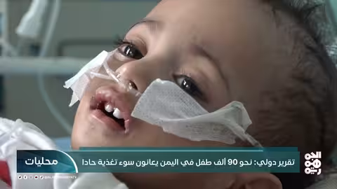 تقرير دولي: 90 ألف طفل يمني يعانون سوء تغذية حاد