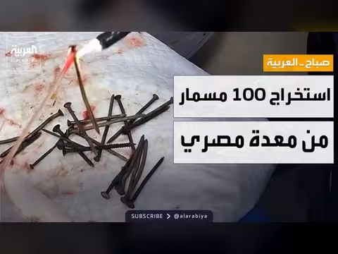 استخراج 100 مسمار من بطن مصري دون جراحة