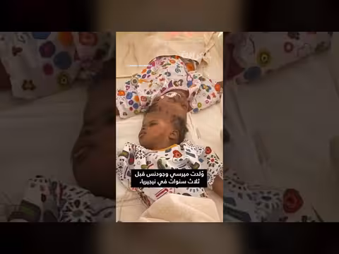 فصل توأم ملتصق باستخدام الذكاء الاصطناعي