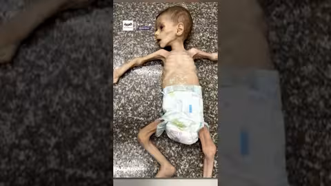 صور مروعة لأطفال في غزة يواجهون المجاعة