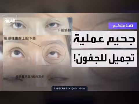 تجميل الجفون يحول حياة صينية لجحيم