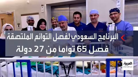 فصل توأمين سياميين سوريين بنجاح في السعودية