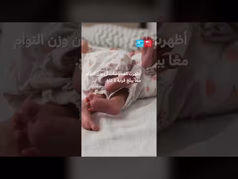 فريق طبي سعودي ينجح في فصل توأم سيامي