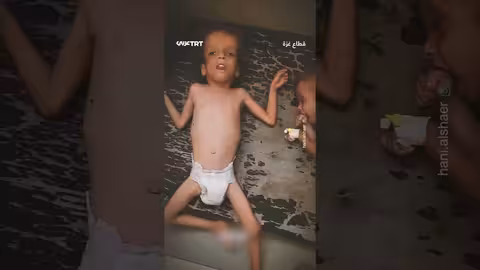 آثار مجاعة على جسدي طفلين فلسطينيين بسبب الحصار الإسرائيلي
