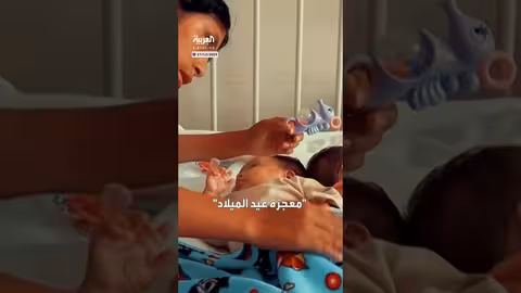 نجاح فصل توأمتين ملتصقتين من العمود الفقري في بيرو