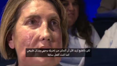 أول زراعة وجه من متبرعة ميتة في برشلونة